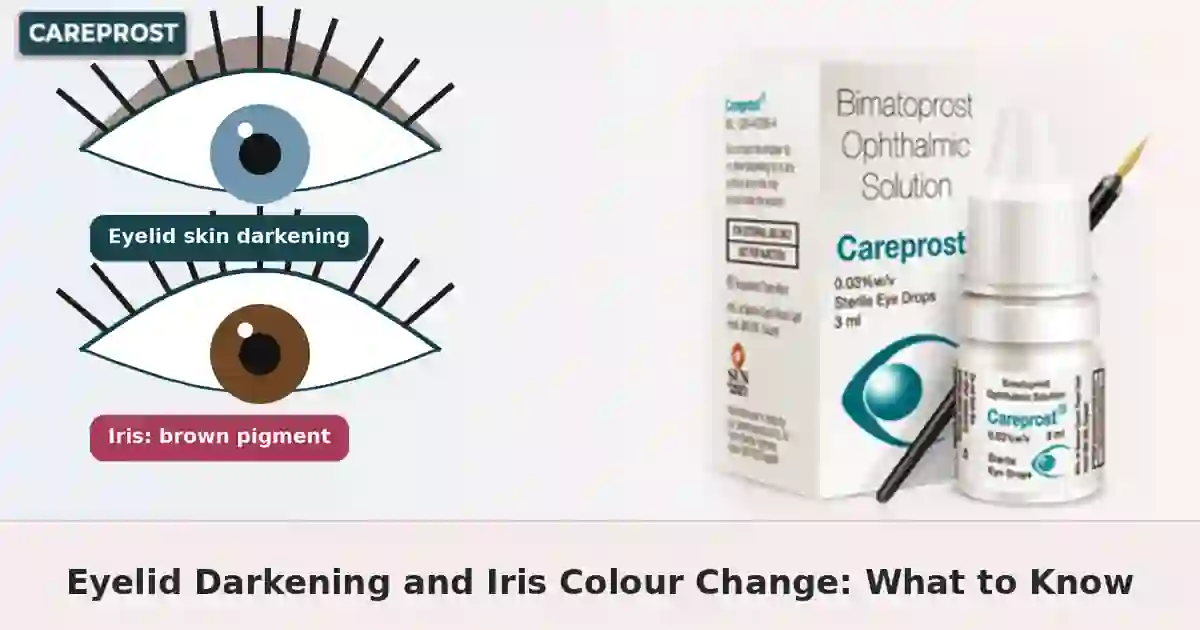 Close-up eye illustration with iris and eyelid shading plus Careprost pack for the article on bimatoprost eyelid darkening and iris colour change