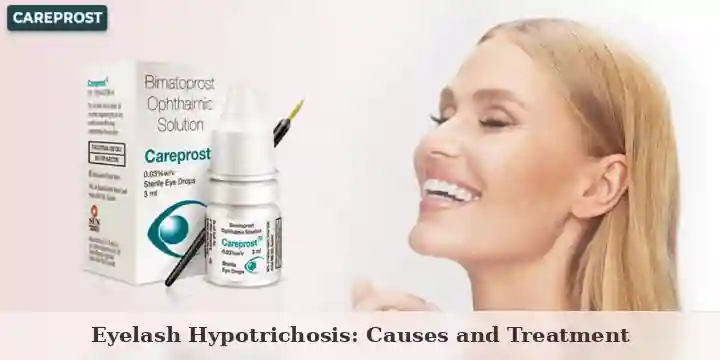 Careprost bimatoprost eye drops box and bottle with a smiling woman, banner for the eyelash hypotrichosis guide